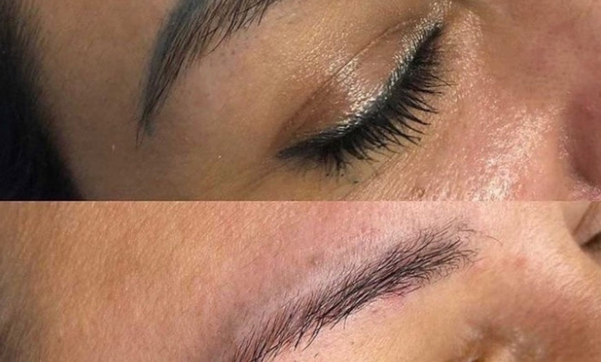 Image 2: Eyebrow Tattoo Removal: Save Up to 30% Off at MB Advanced Beauty MED!