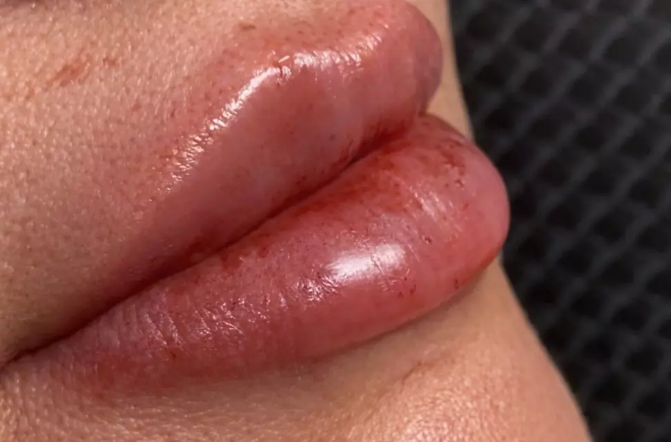 Lippen-Auffüllung mit bis 0,5 ml Hyaluron für 1 Person