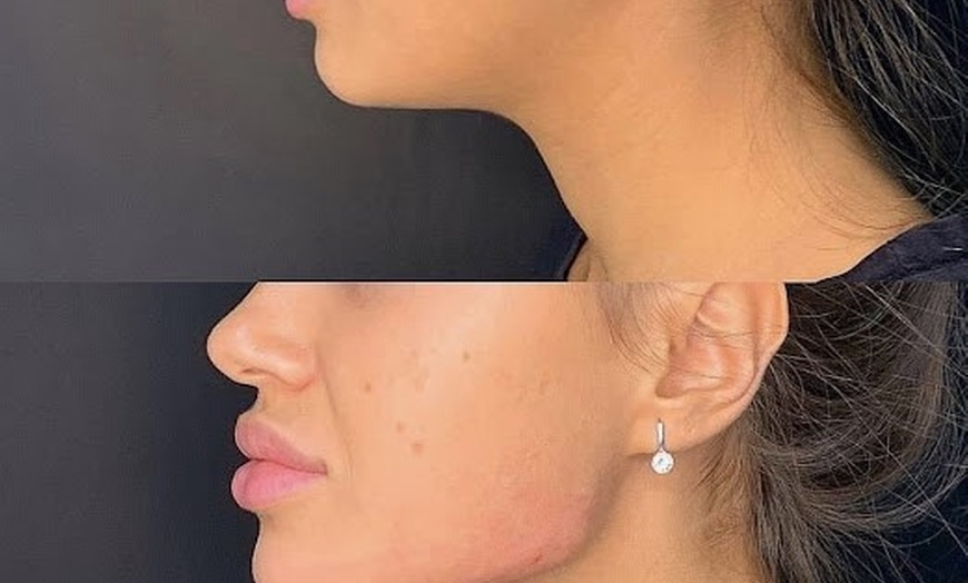 Image 6: One Session of 0.5ml,1ml or 2ml Dermal Filler With Consultation