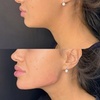 Image 6: One Session of 0.5ml,1ml or 2ml Dermal Filler With Consultation