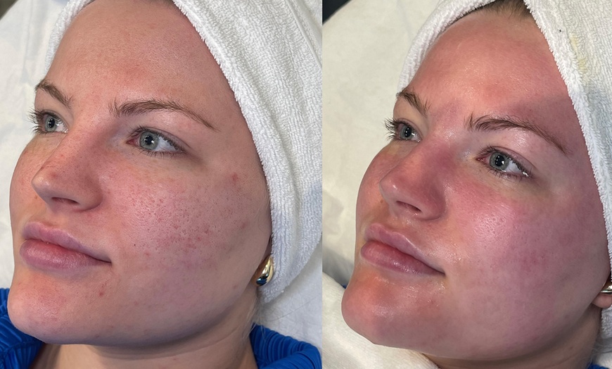 Image 6: 1x oder 2x 60 Min. Derma-Pen-Needling-Gesichtsbehandlung für 1 Person