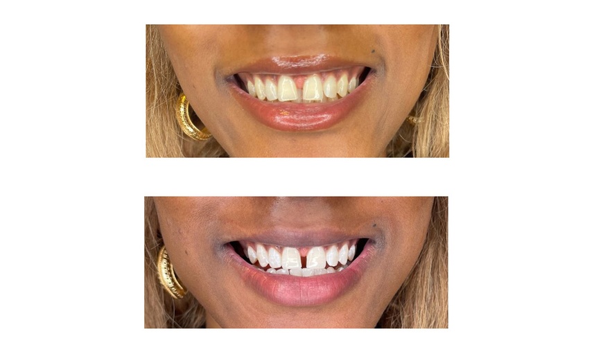 Image 9: Teeth Whitening - In-Office - Non-Branded at Splendida