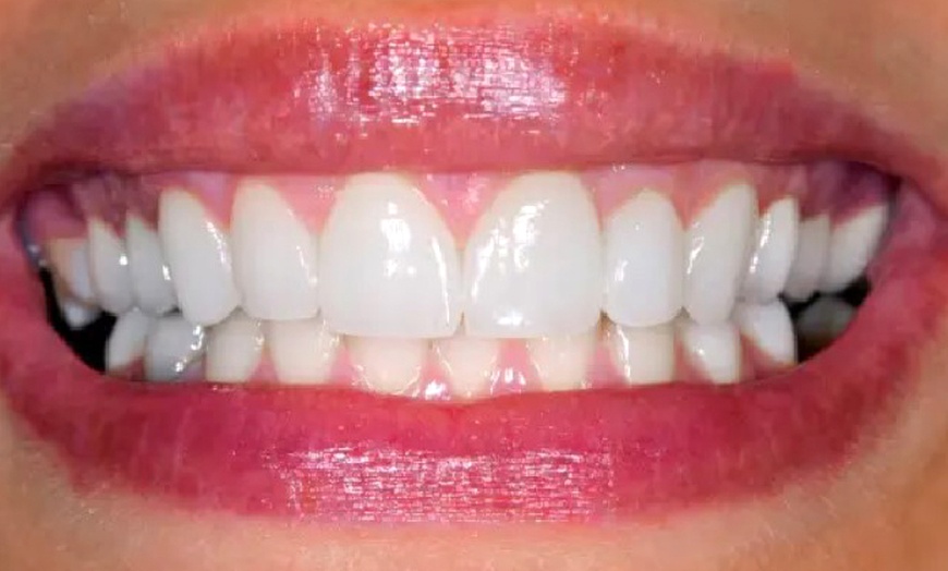 Image 1: Blanqueamiento dental con led en Clínica Dental Odontoss