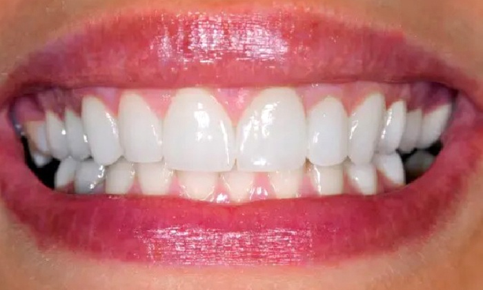 Blanqueamiento dental con led en Clínica Dental Odontoss