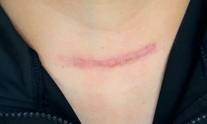 Achieve Smooth Skin with  Scar Removal with Fractional CO Laser