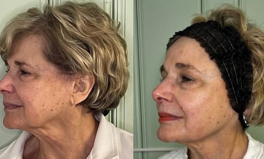 Image 3: Opus Plasma Skin- Resurfacing Session for the Face & Neck