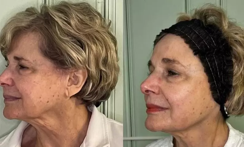 One or Three Sessions of Opus Plasma Skin- Resurfacing Session for the Face and Neck (Up to 50% Off) - Second Medium
