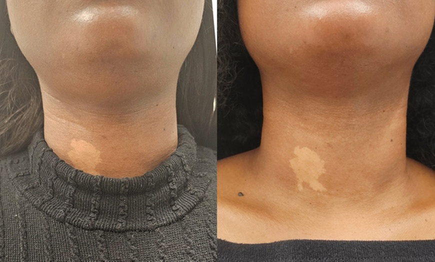 Image 1: Targeted Fat Reduction with One or Two Vials of Kybella