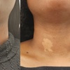 Image 1: Targeted Fat Reduction with One or Two Vials of Kybella