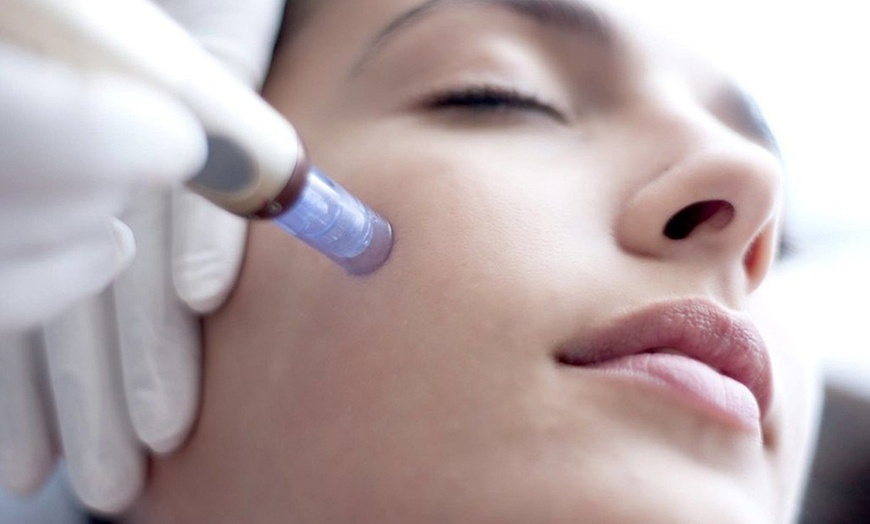 Microneedling Treatment at Elysian Aesthetics And Wellness Clinic