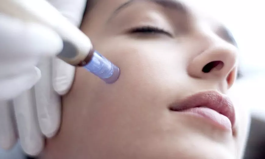 Microneedling Treatment at Elysian Aesthetics And Wellness Clinic (Up to 56% Off) - Primary Image