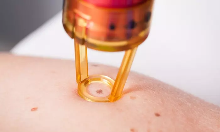 Sisters Semi Permanent Make Up Salon offers removal of skin tags and spots up to 50% off, with options for all needs - Primary Image