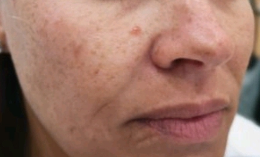 Image 2: Revitalize Your Skin with IPL Photofacial Treatments