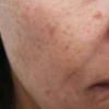 Image 2: Revitalize Your Skin with IPL Photofacial Treatments