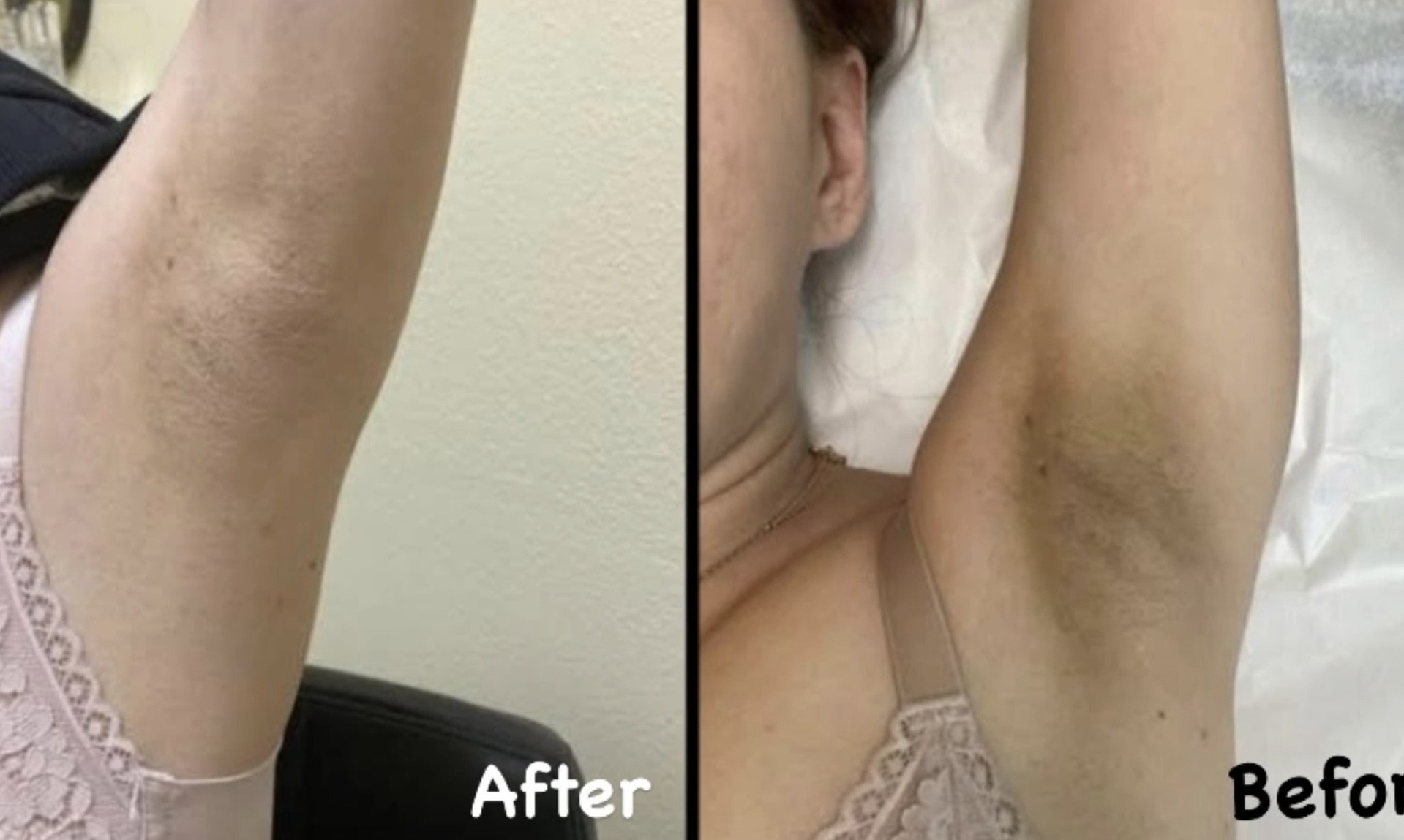 Skin bleaching sessions for large areas available