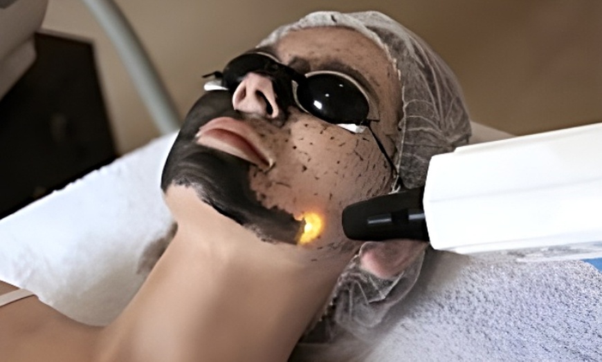Image 11: Hollywood peeling con carbón activo y láser o limpieza facial prémium 