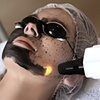 Image 11: Hollywood peeling con carbón activo y láser o limpieza facial prémium 