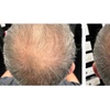 Image 7: Fuller & Healthier Scalp: 2, 4, or 6 Procell Hair Restoration Sessions