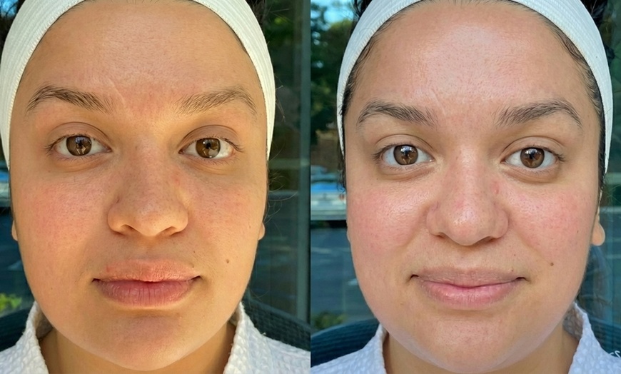 Image 2: One HydroDiamond™ Hydrodermabrasion with Optional Add-On LED Treatment