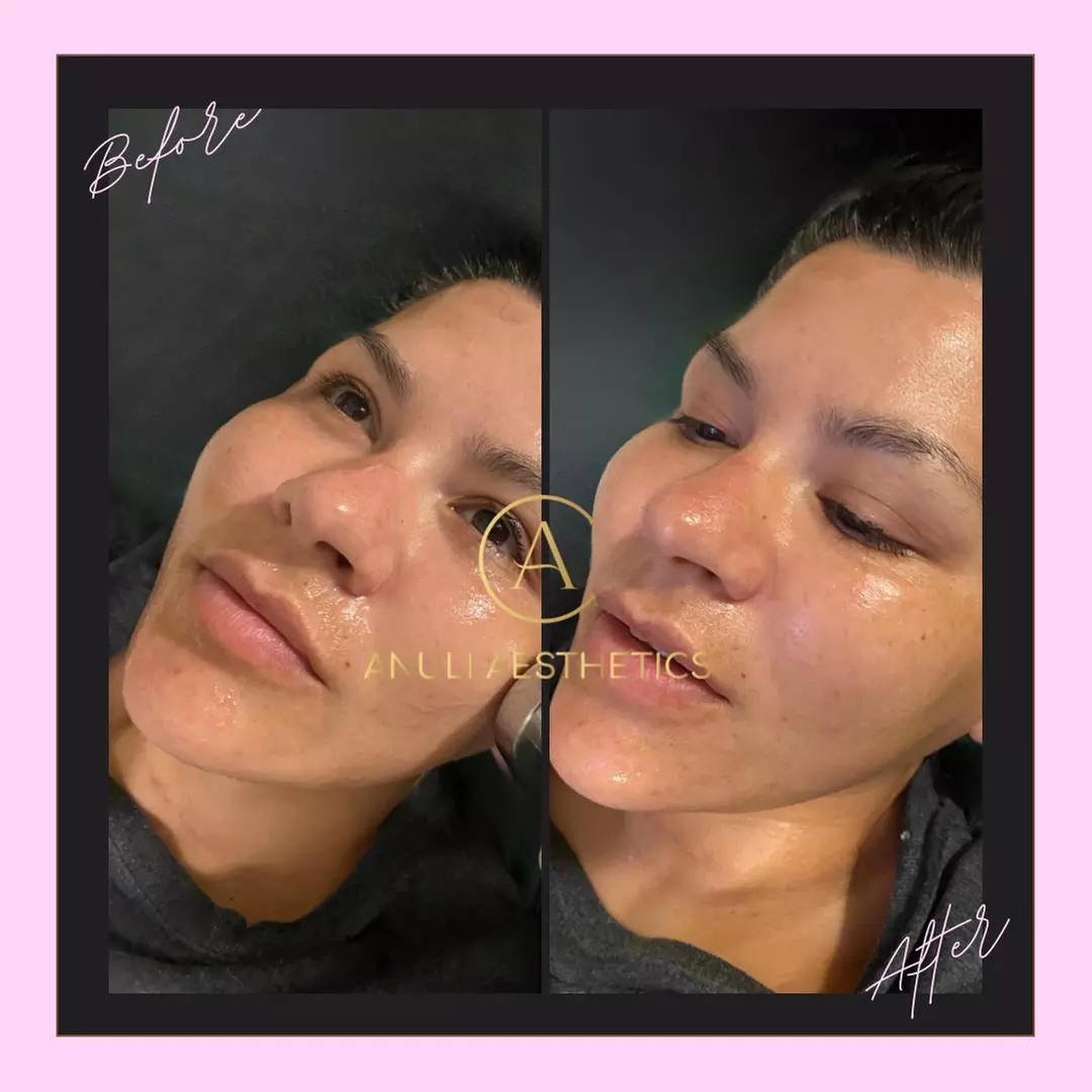 Up to 87% Off High Frequency Ultrasonic Fat Reduction  at Anuli Aesthetics & Weightloss - Second Medium