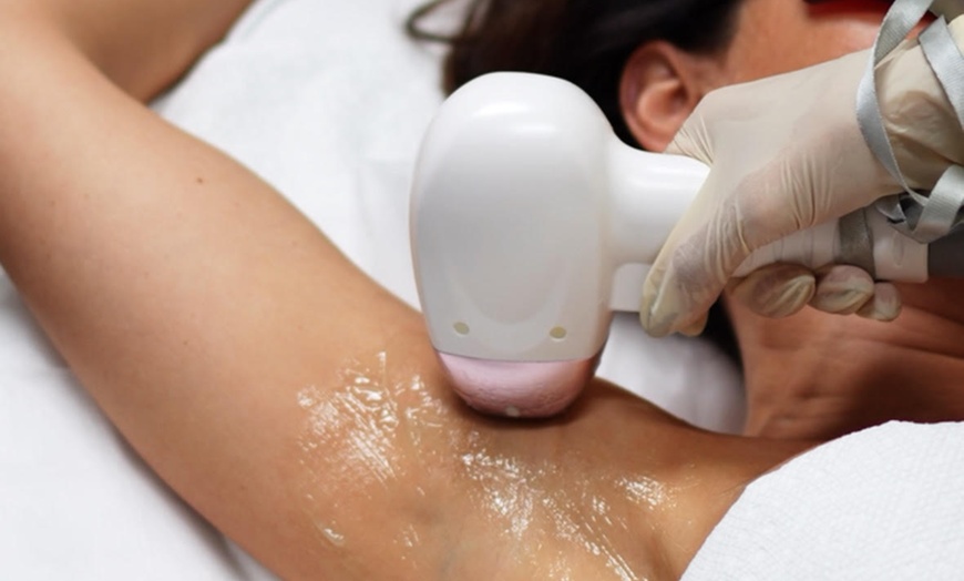 Image 3: 6 Laser Hair Removal Session-1 Small, Medium Large or Extra Large Area
