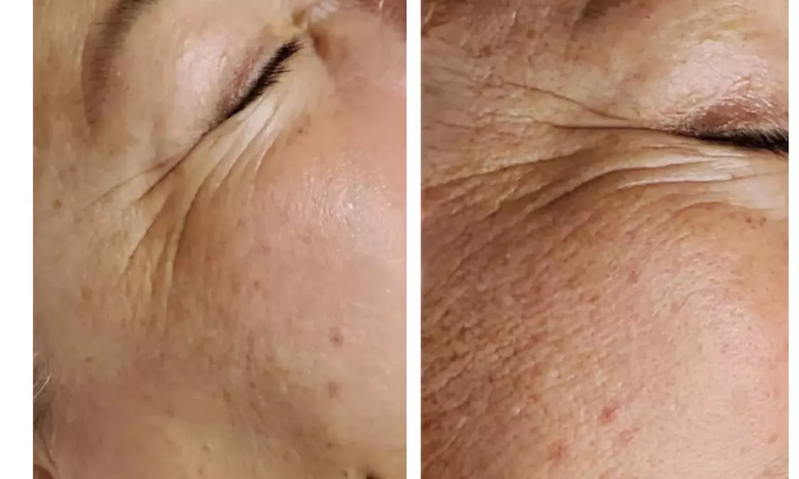 Microdermabrasion with Optional Facial Mask & Shoulder Relaxation