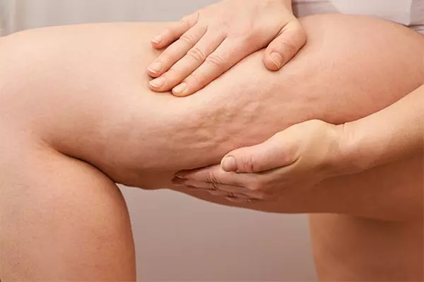 Achieve Body Goals: Four or Six Cellutone Sculpting Treatments