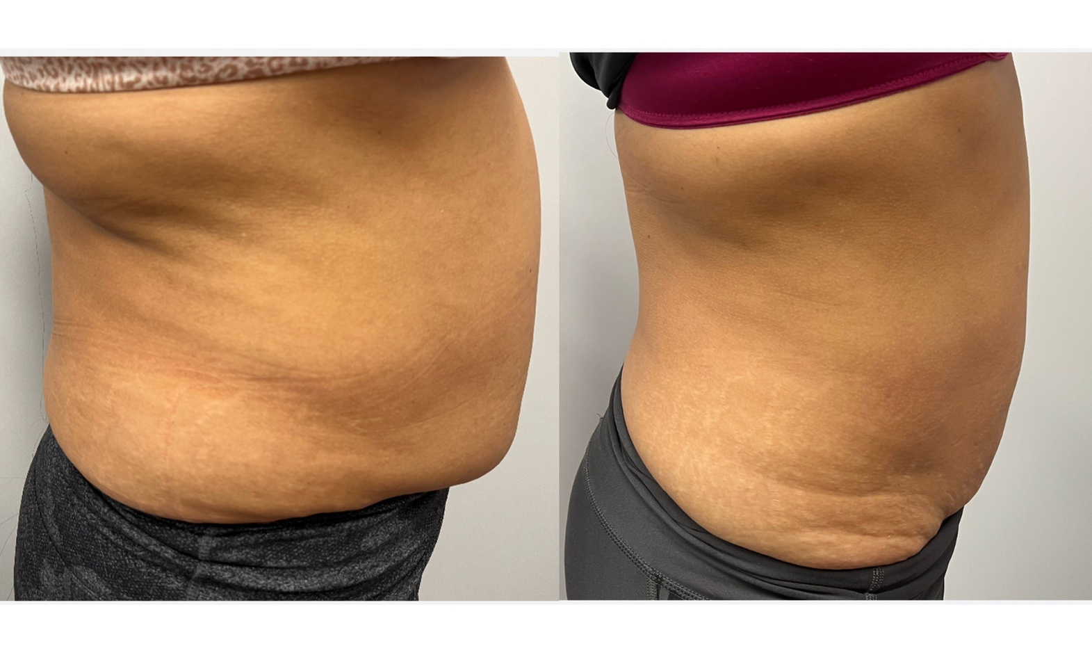 Body-sculpting and RF skin tightening treatments for all needs