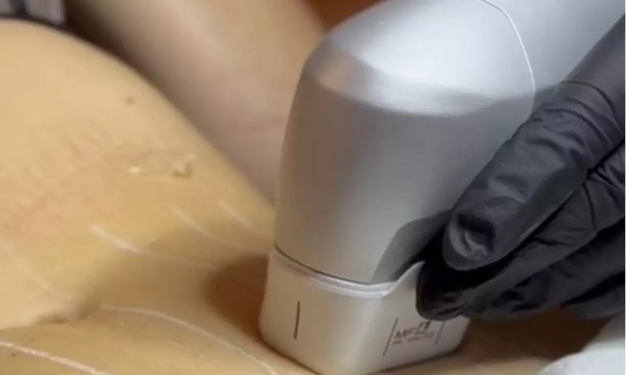 Zachowaj młodość dzięki nowoczesnym zabiegom systemem HIFU