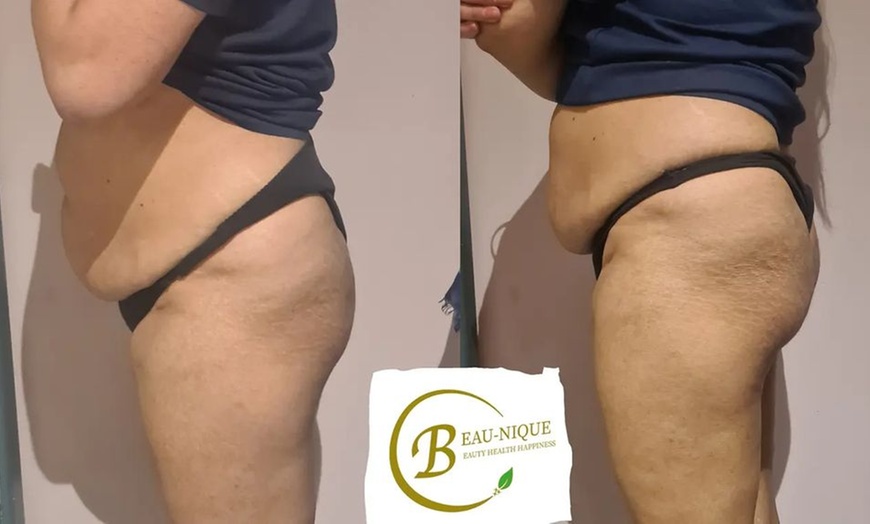 Image 5: Expert Body Sculpting with Laser Lipo, Cavitation or Radiofrequency