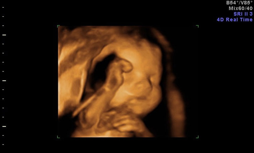 Image 10: 3D/ 4D Baby Scan