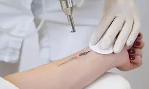 Elimina tatuajes con sesiones en zona a elegir utilizando técnicas avanzadas, hasta 96% de descuento