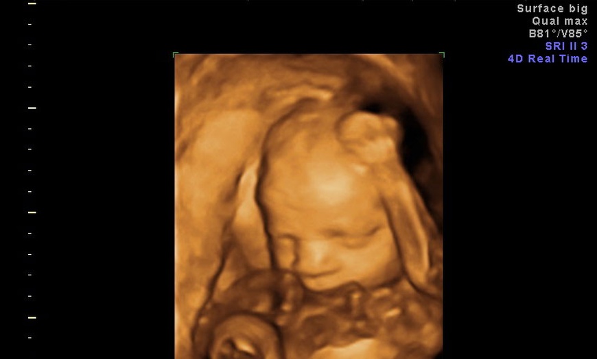 Image 7: 3D/ 4D Baby Scan