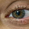 Image 2: Up to 20% Off on Facial - Blemish Treatment at Aero Laser and Skin