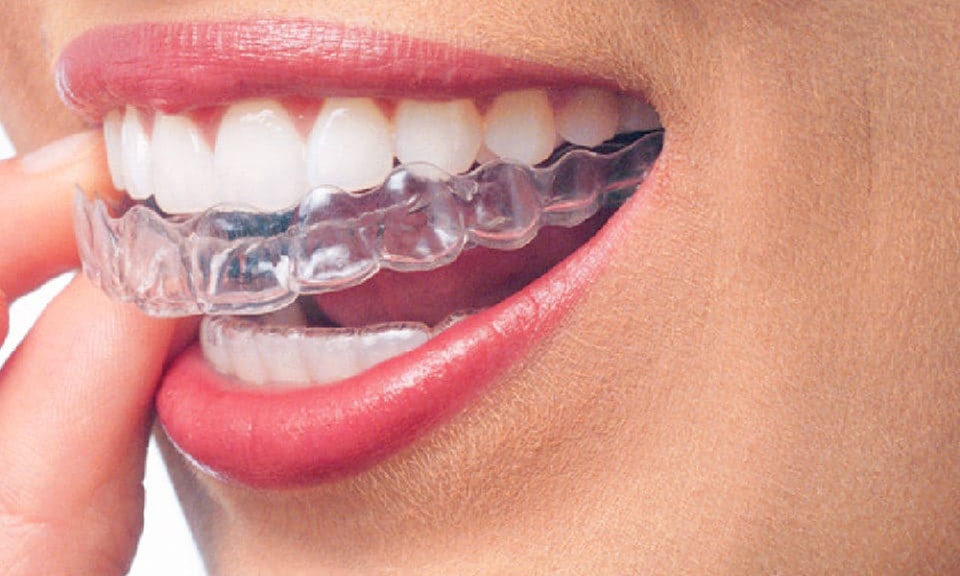 Paga 89 € y obtén un descuento de 2000 € en tratamiento Invisalign con PerfectDent