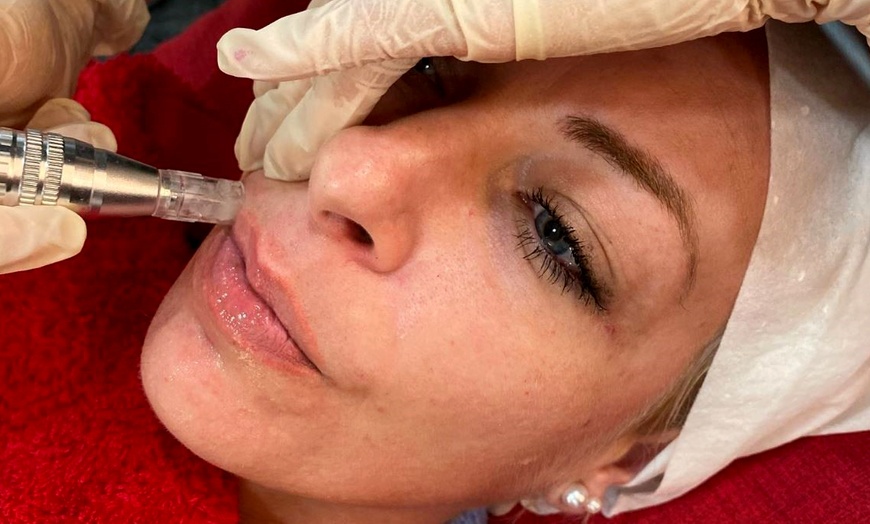 Image 3: 1 o 3 sesiones de dermapen facial con vitaminas o exosomas