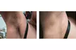 A-ONE Laser Clinic: Three Laser Hair Removal Sessions for Small, Medium or Large Area (Up To 75% Off) - Second Medium