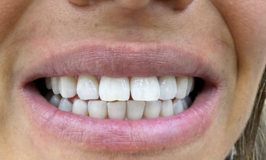 Image 2: Bis zu 53% Rabatt auf den  bei SKBeauty