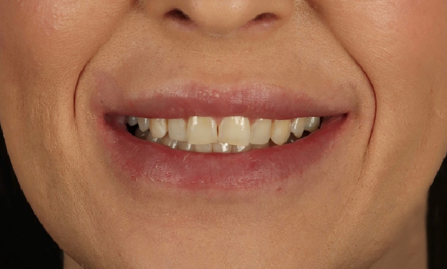 Image 3: Composite Bonding with Whitening at Poynton Dental Practice