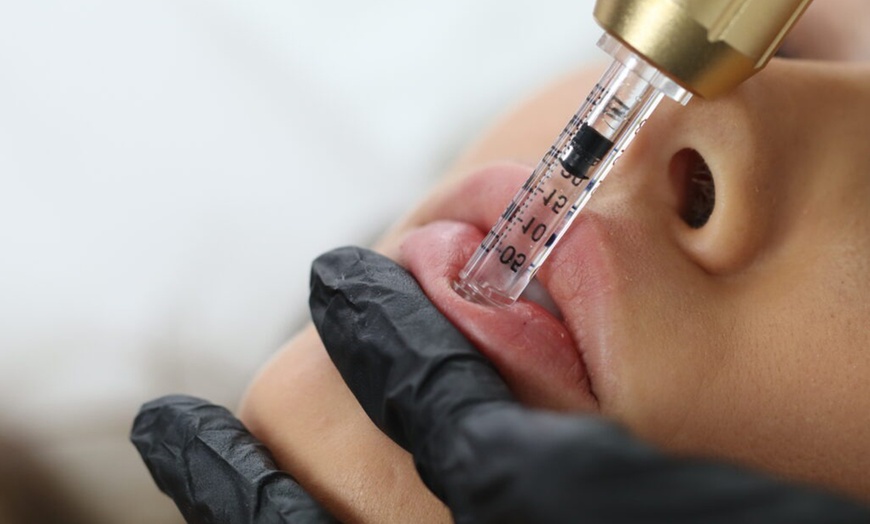Image 3: 1 o 2 sesiones de rehidratación de labios o microlifting facial para 1