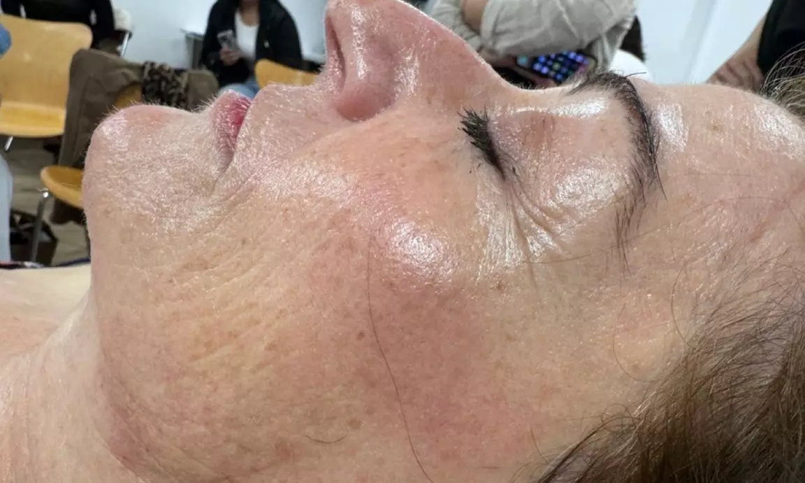 1 o 2 sesiones de exosomas con dermapen en 2 fases para rostro completo con un 55% de descuento para una persona - Primary Image