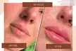 Perfect Your Pout with Dermal Filler - 0.5ml or 1ml  (Up To 60% Off) - Image 2