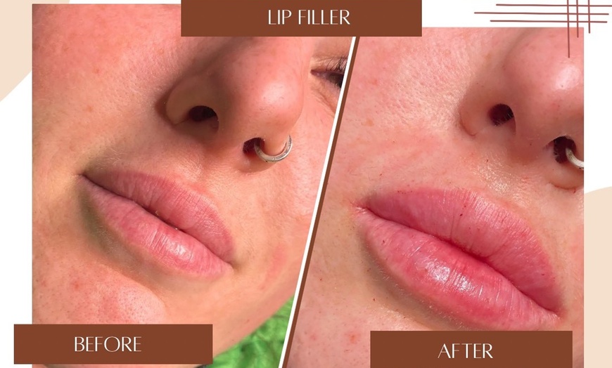 Image 3: Define Your Lips with Expertly Applied 0.5ml or 1ml Dermal Filler 