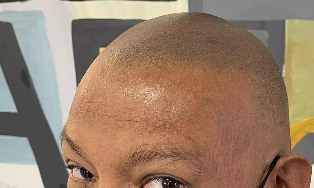 Scalp Micropigmentation Sessions for Various Hair Loss Levels