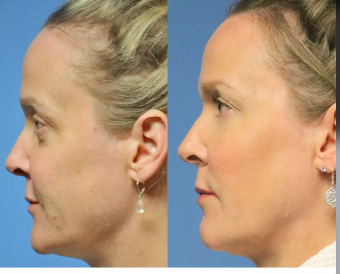 Up to 11% Off on Injection - Dermal Filler at Original Skin - Second Medium