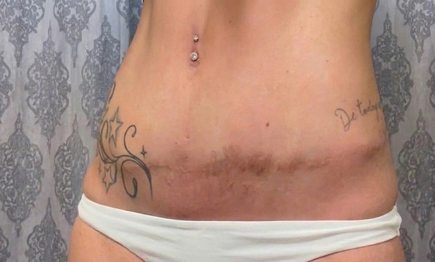 Image 3: Advanced PMU: Improve Scars & Stretch Marks for Smoother Skin