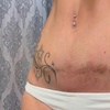 Image 3: Advanced PMU: Improve Scars & Stretch Marks for Smoother Skin