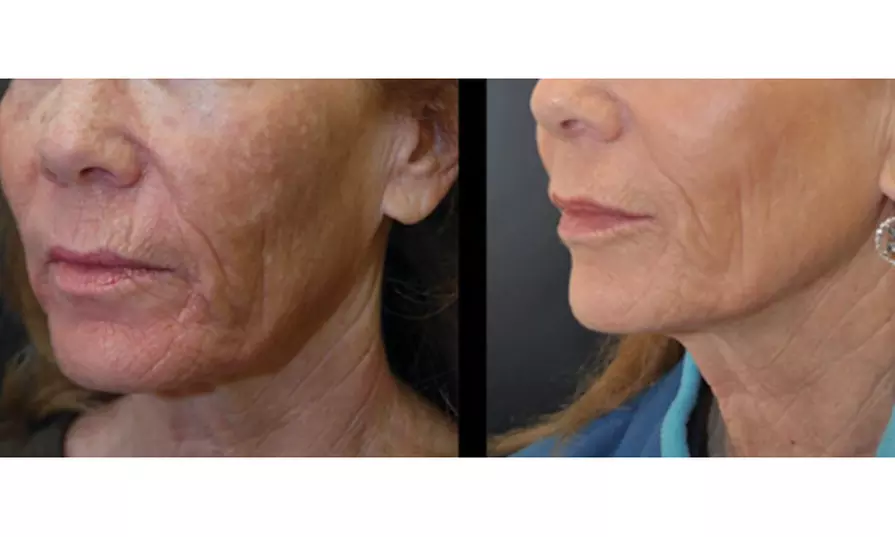 Non-Invasive HIFU Treatments for Crow's Feet, Chin & More
