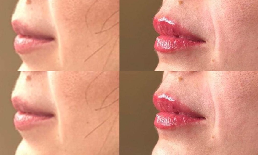 Image 1: Hyaluronic Acid Pen Dermal Filler - Lips at Envyyme