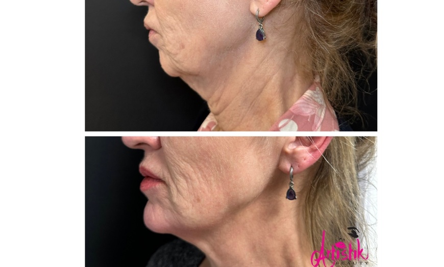 Image 3: PDO Thread Lift Treatment for Cheek & Jowl w/ Optional Neck & Jawline